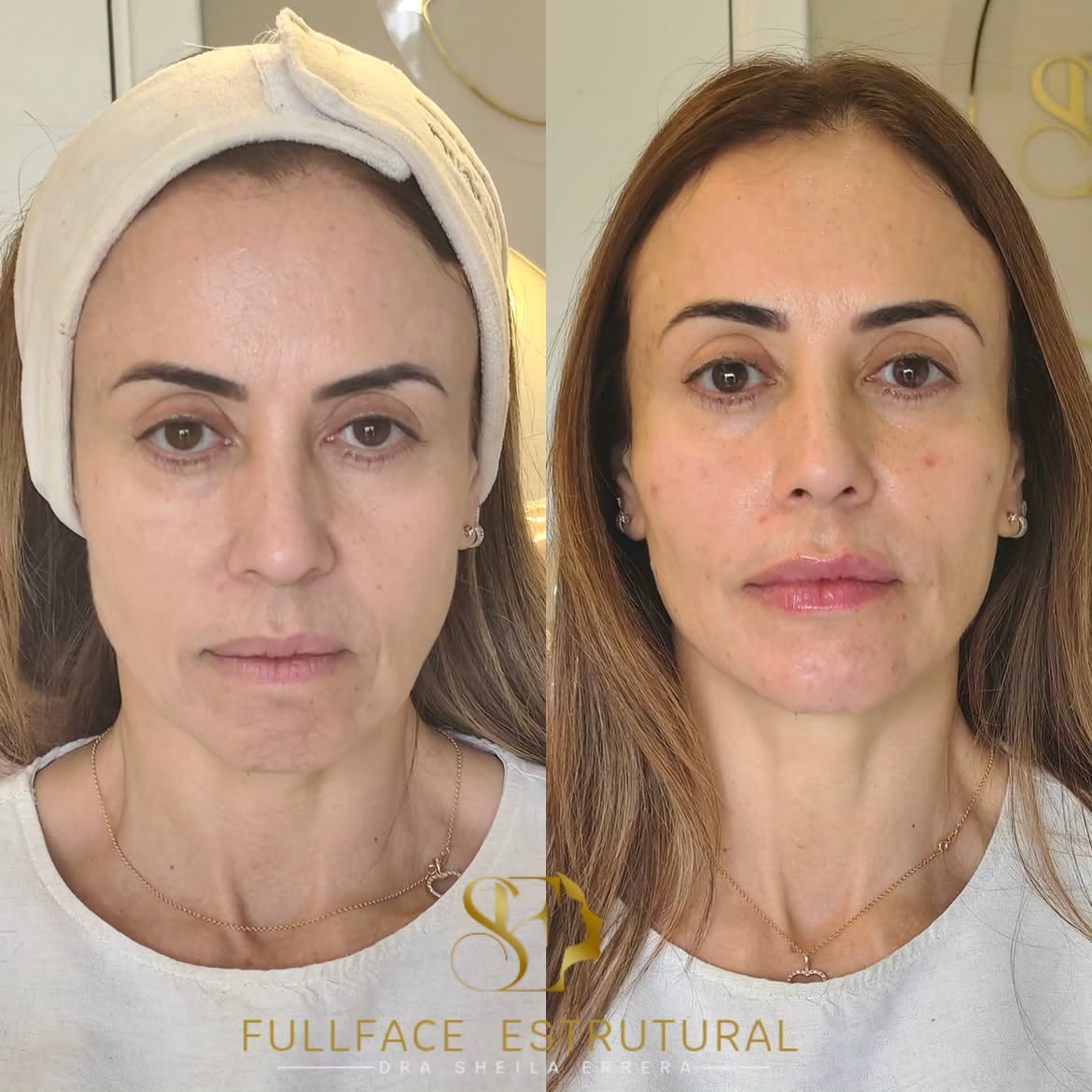 Caso 3 — antes e depois do FULLFACE