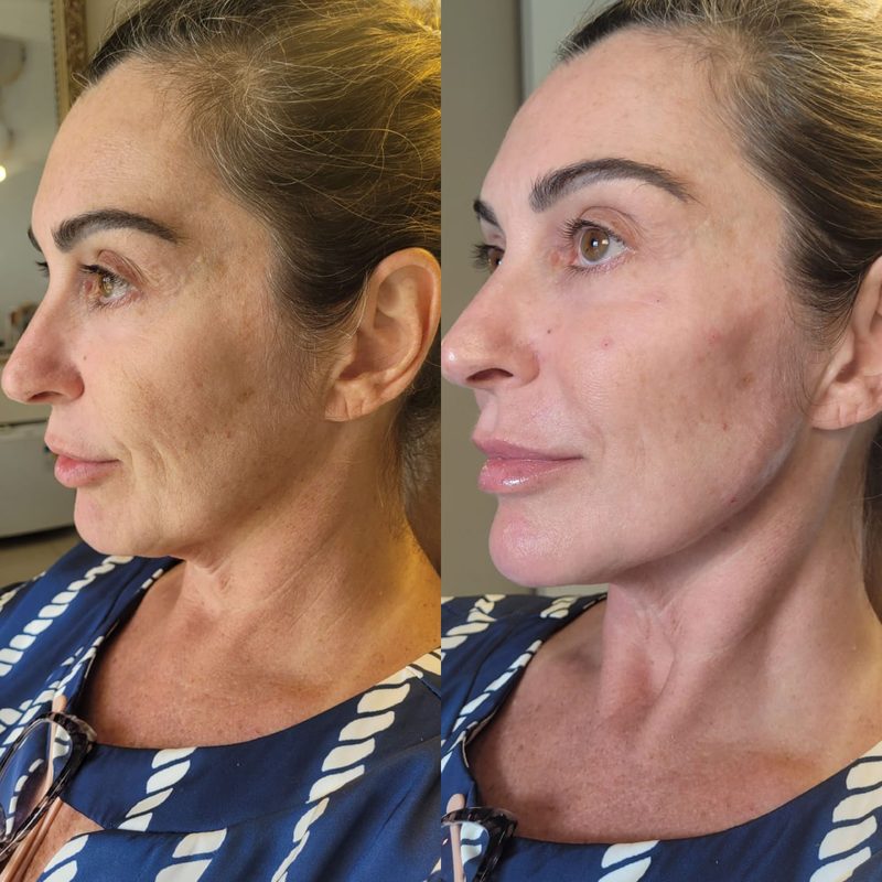 Caso 1 — antes e depois do FULLFACE