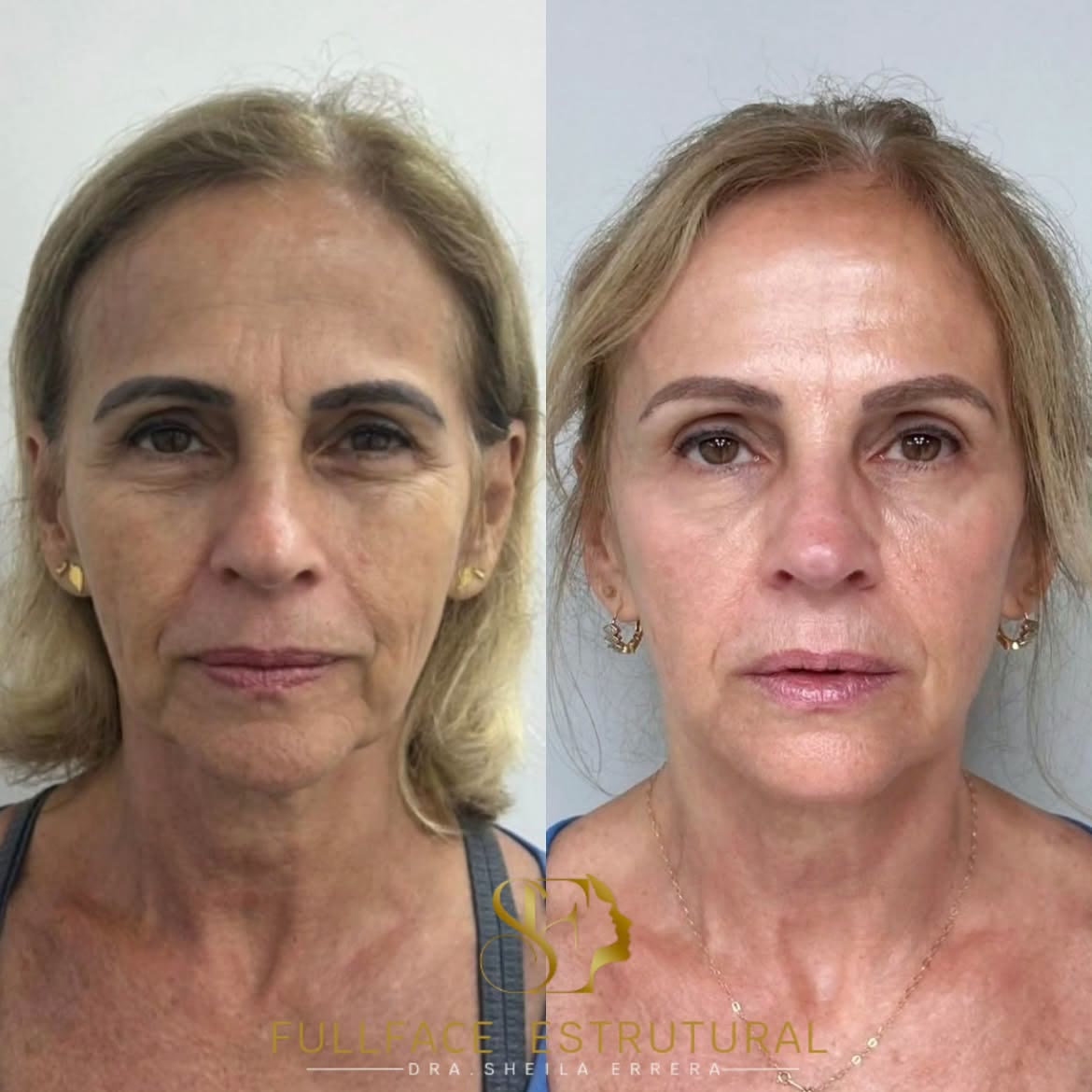 Caso 1 — antes e depois do FULLFACE