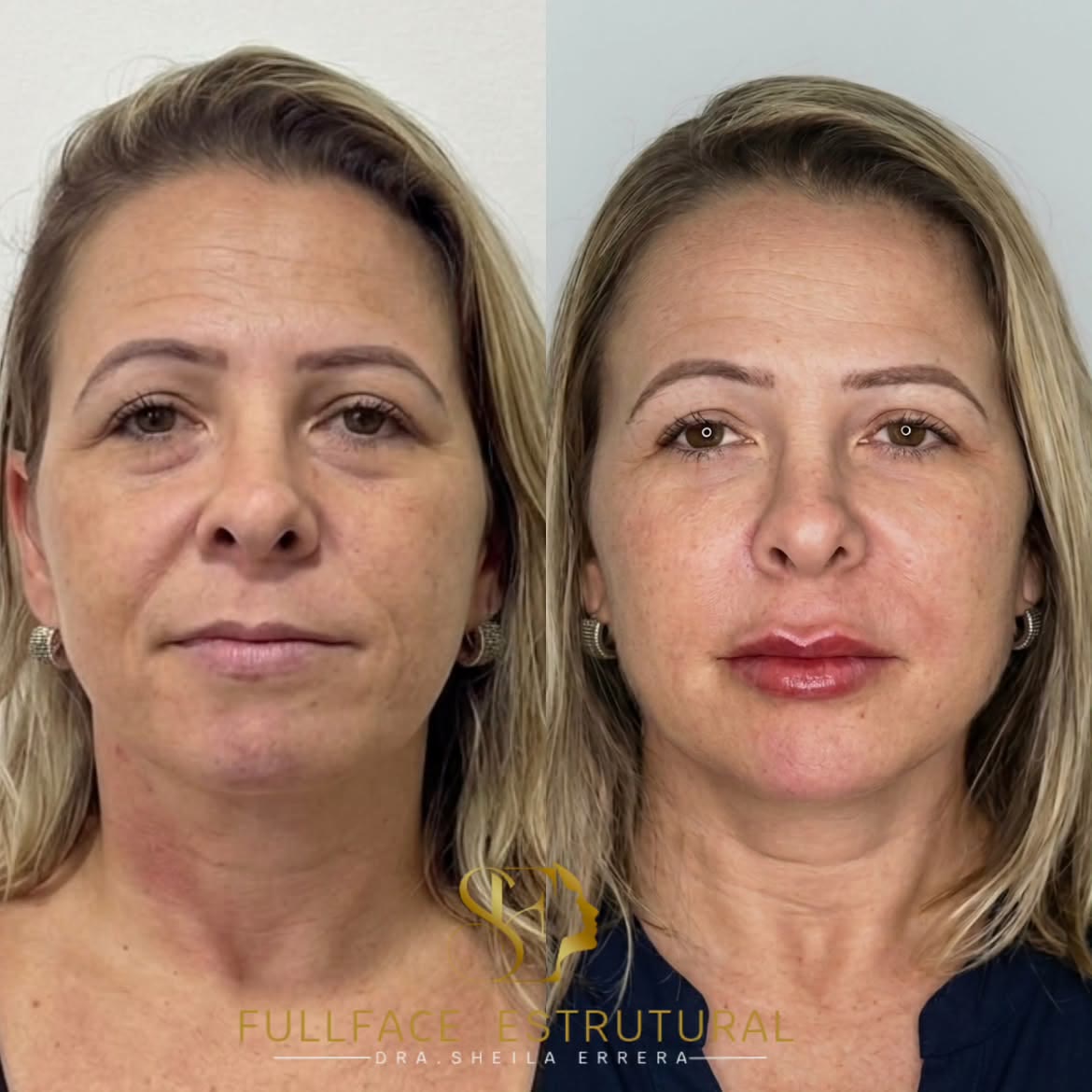 Caso 4 — antes e depois do FULLFACE