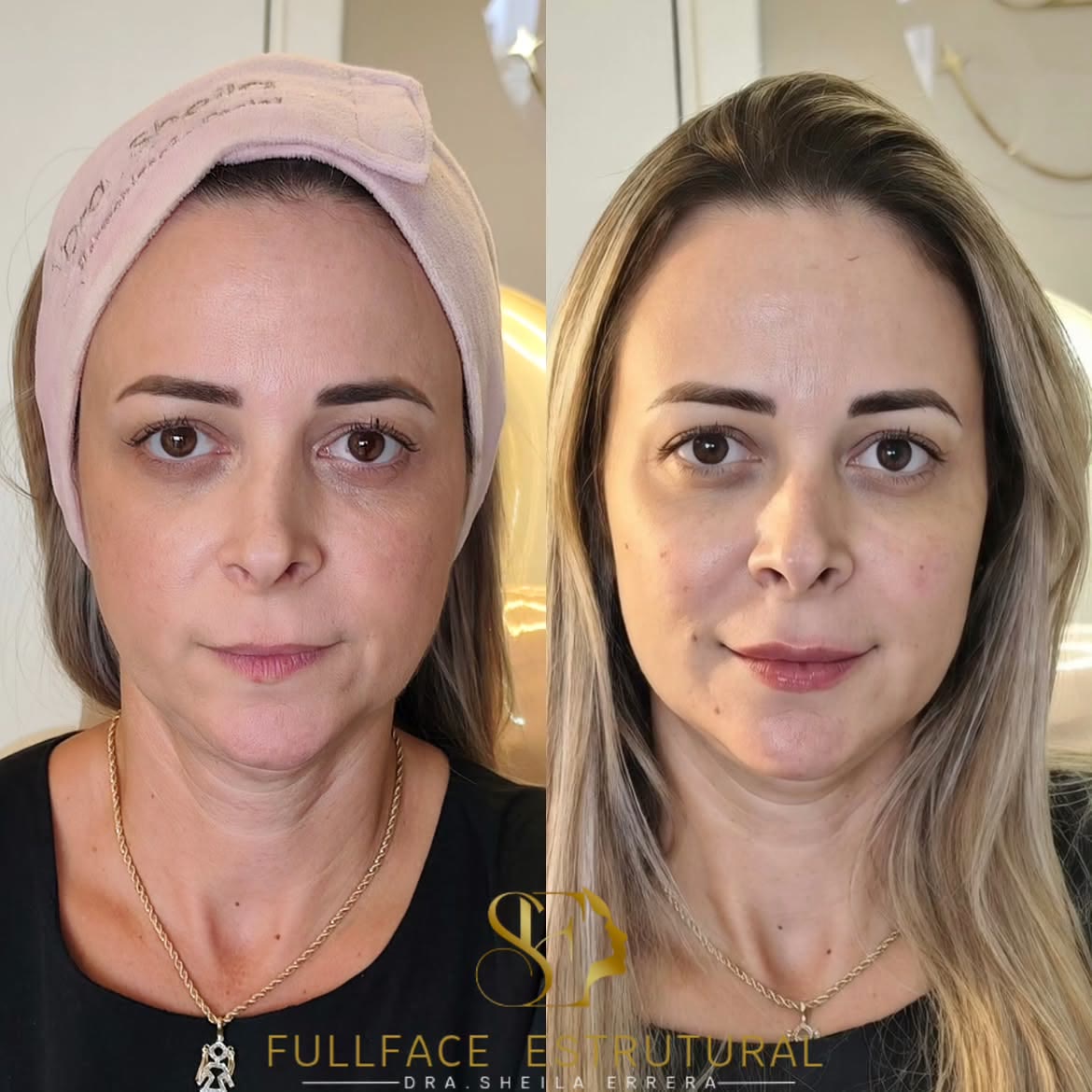 Caso 2 — antes e depois do FULLFACE
