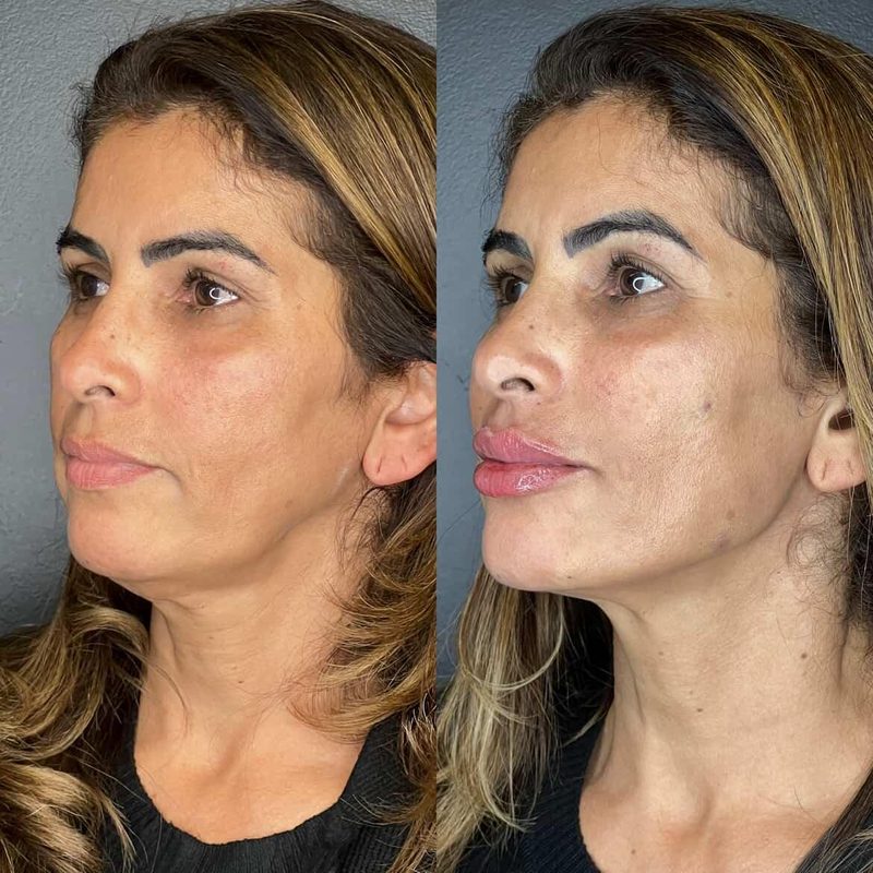 Caso 2 — antes e depois do FULLFACE